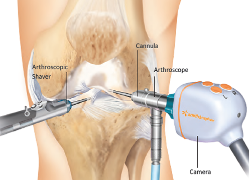 Arthroscopy Procedure Illustration